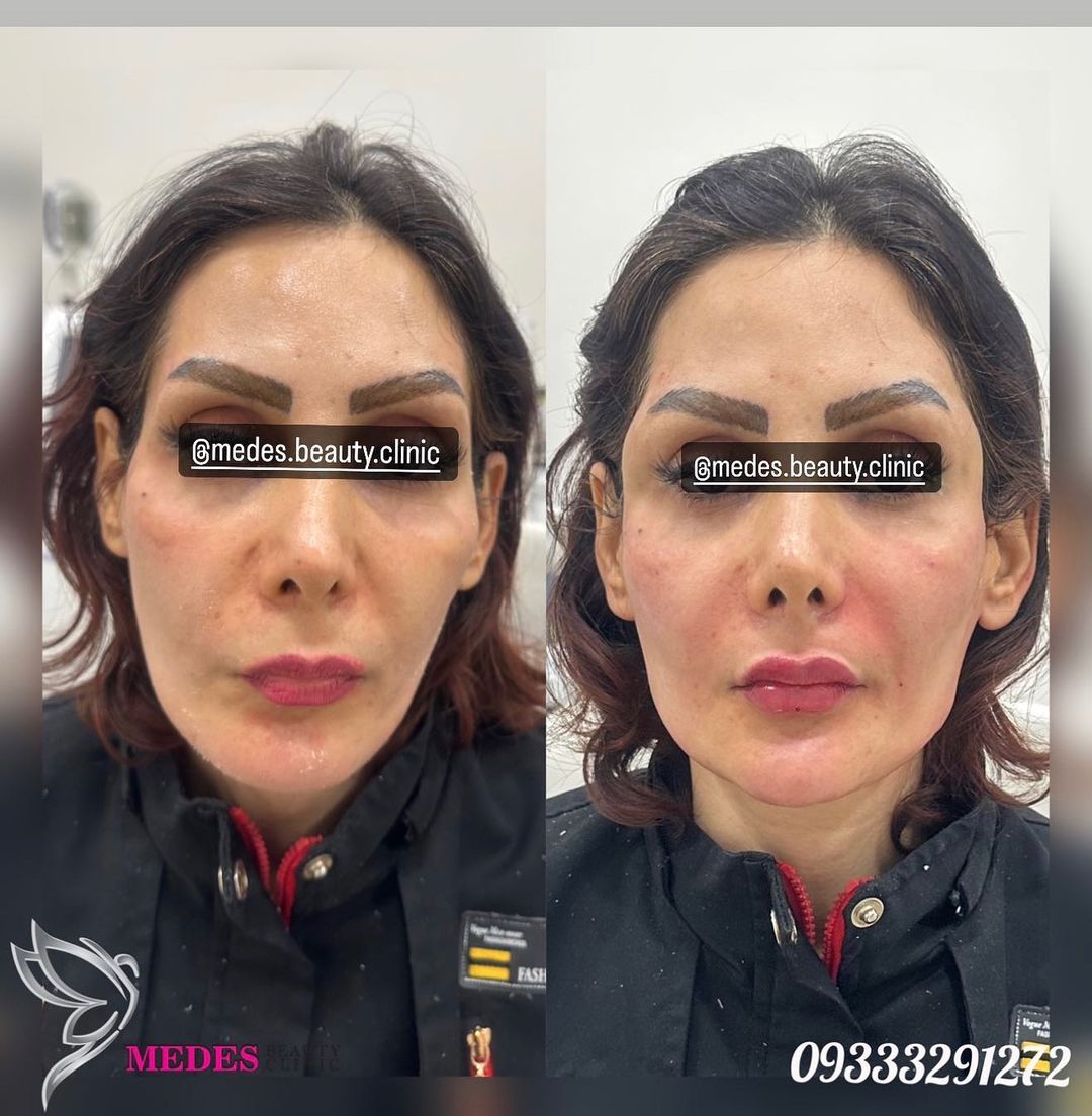 گالری زاویه سازی صورت